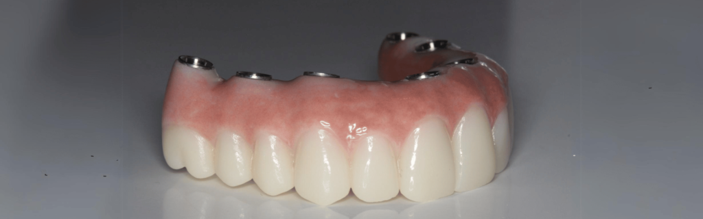 all-on-4 dental implant shown before implant