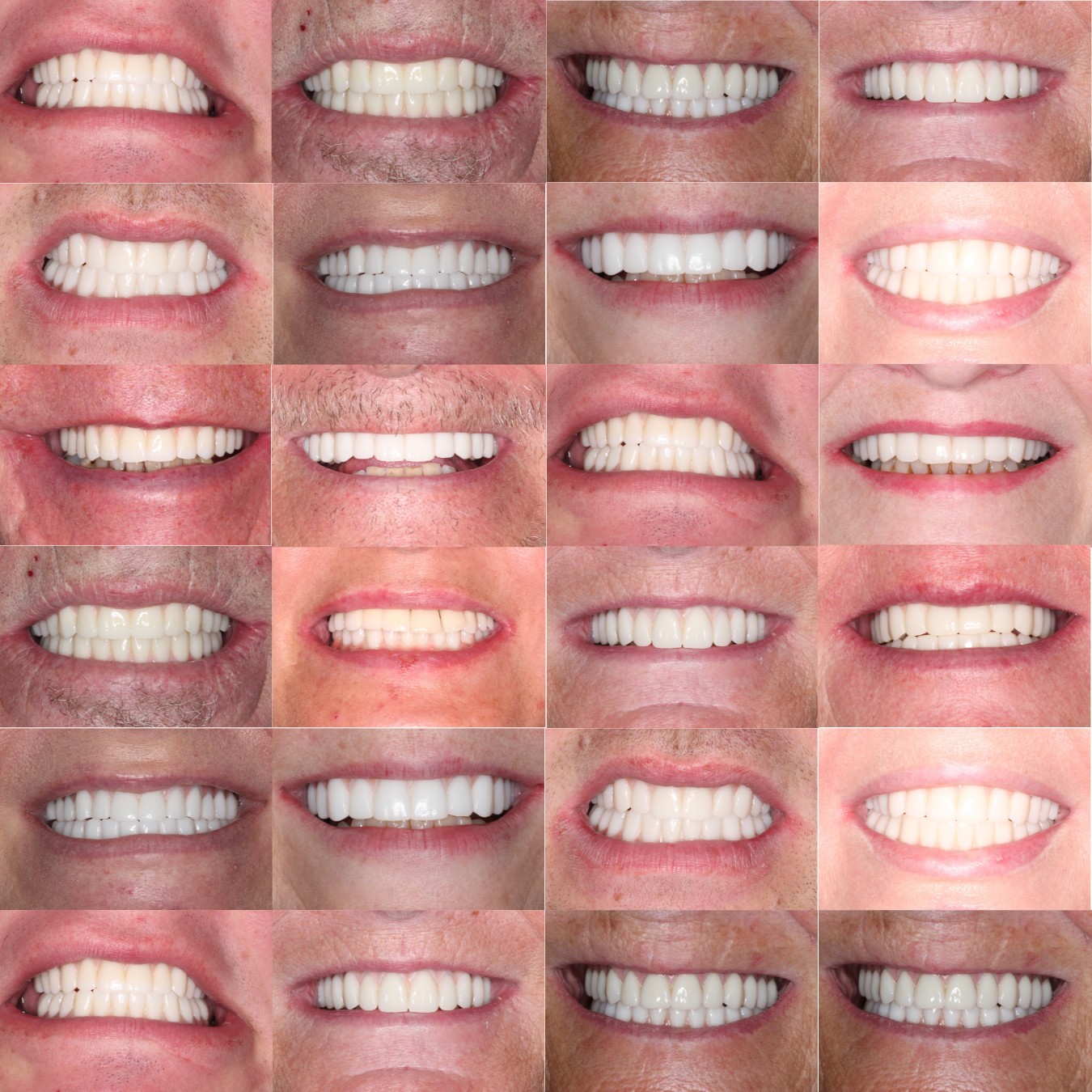 Dental Implants Glasgow