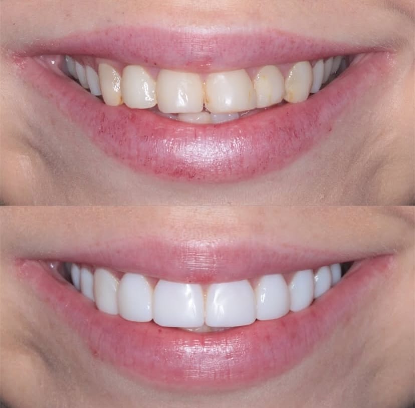 Teeth In A Day