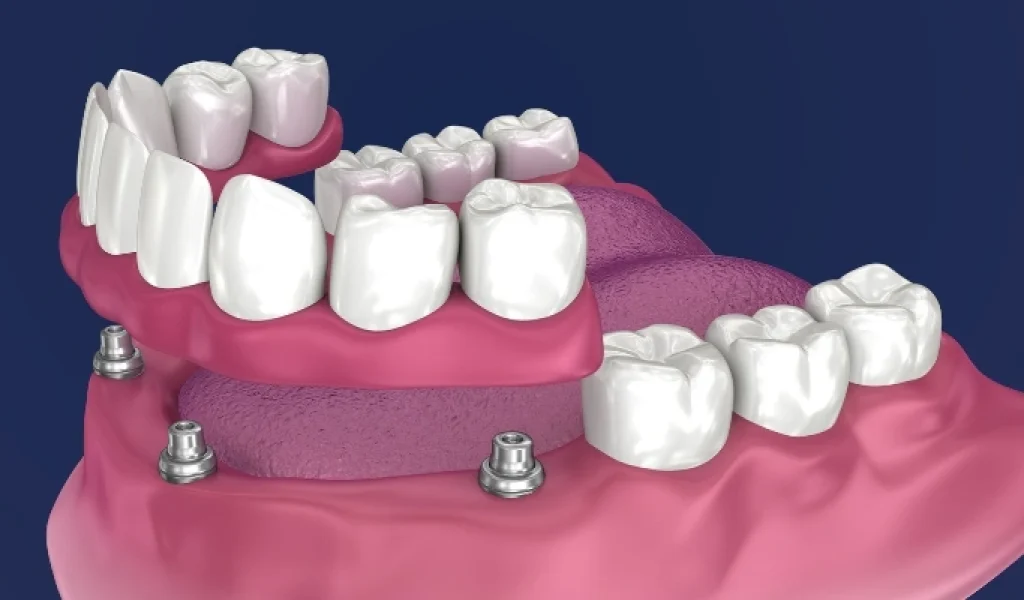 How many teeth do all-on-4 implants have