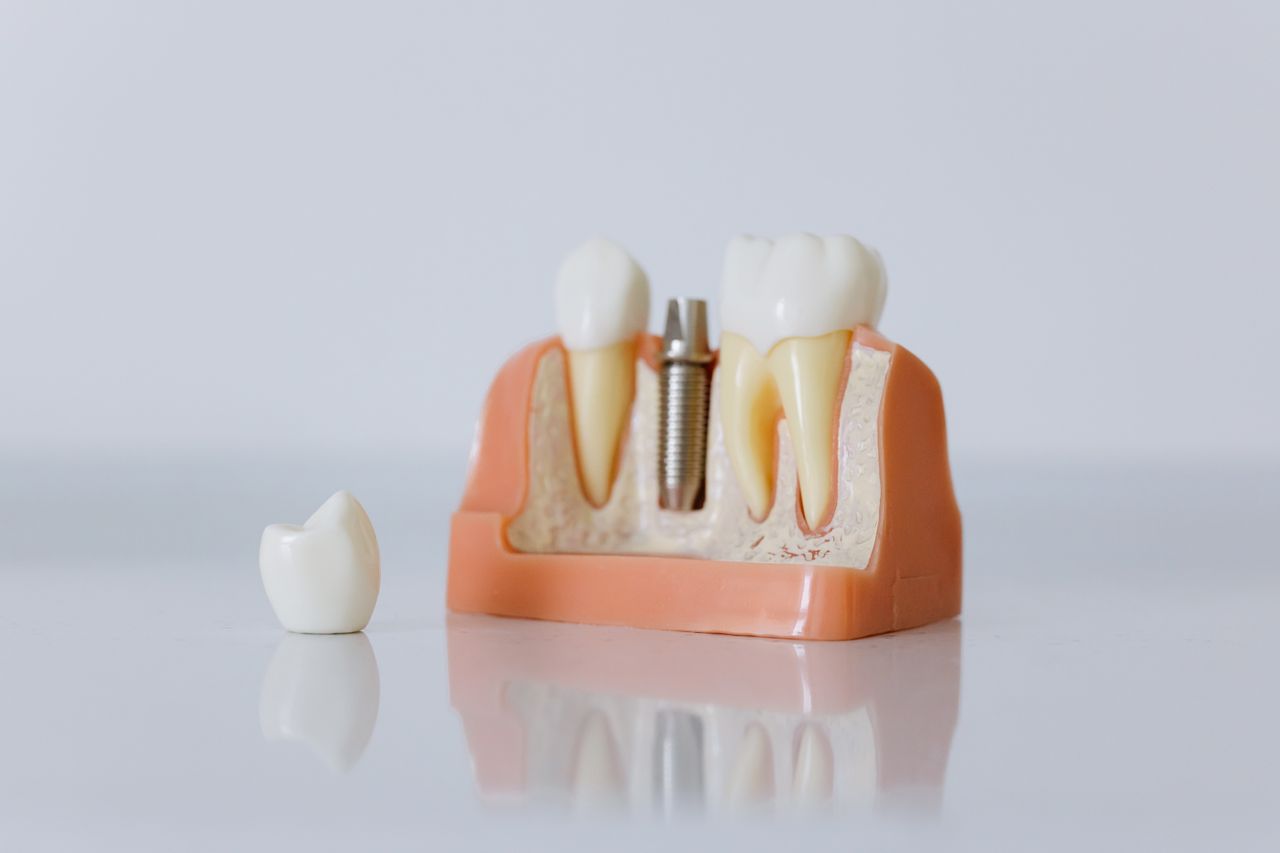 Teeth In A Day